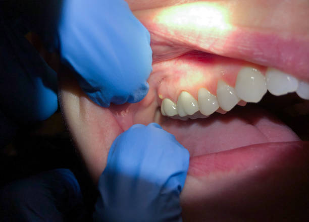 Best Chipped Tooth Repair Near Me  in Willow Oak, FL