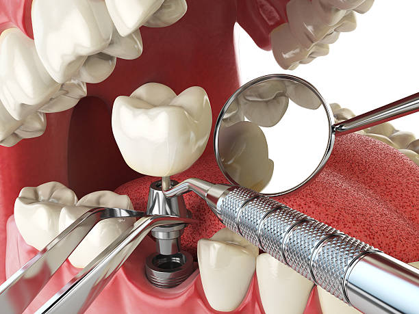 Best Tooth Infection Emergency Dentist  in Willow Oak, FL